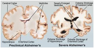 Advanced Alzheimer’s Disease